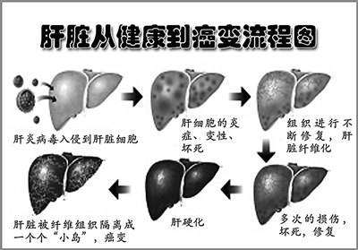 《解放軍報》:第二軍醫大學最新成果為肝癌病人送去福音